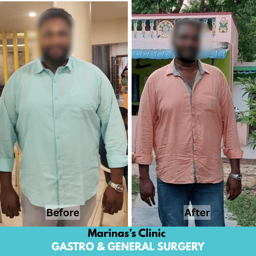 Patient Transformation before and after bariatric treatment