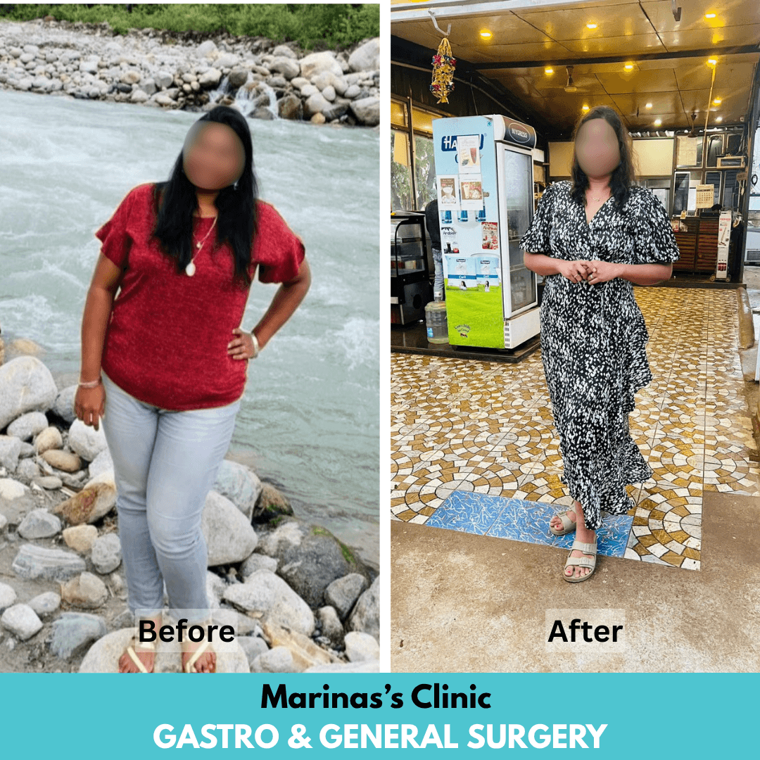 Weight Loss Journey before and after bariatric treatment