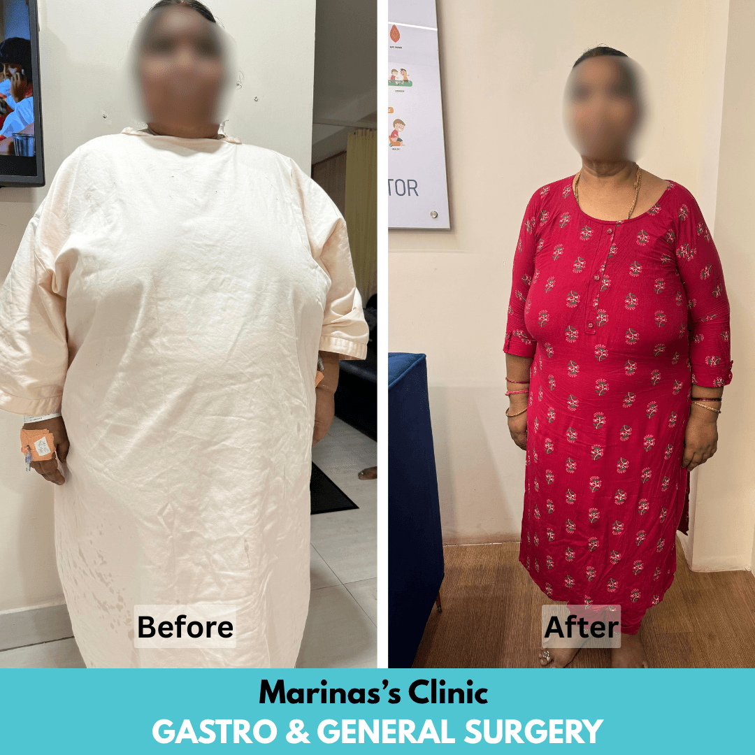 Life After Treatment before and after bariatric treatment